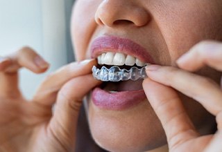 Closeup of patient putting on clear aligner