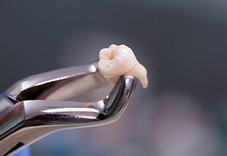 A tooth that has been extracted in a forceps