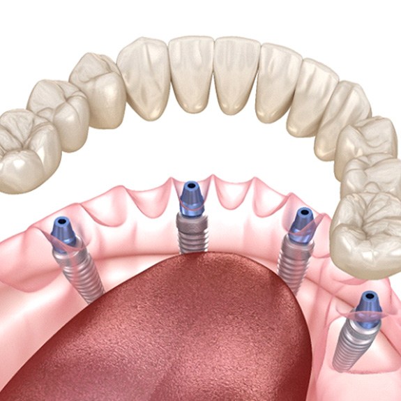 Digital illustration of all-on-4 dental implants