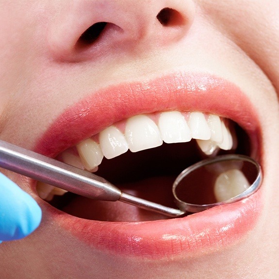 Dentist examining patient's tooth colored filling