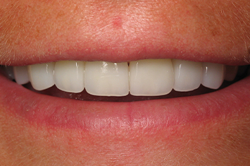 Brillian smile after procelain veneers