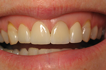 Smile perfected by porcelain veneers