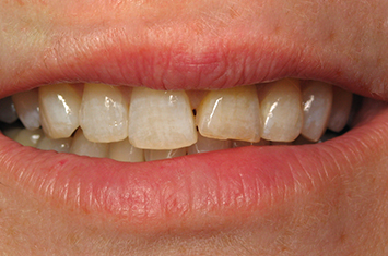 Slightly crooked and discolored teeth before porcelain veneers