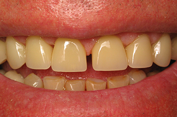 Healthy attractive smile after dental crown restoration