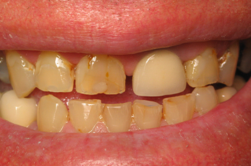 Smile with dental damage and decay before dental crown restoration