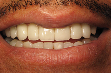 Smile with natural looking dental crown restorations