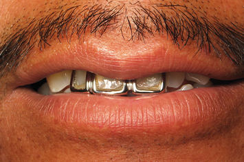 Smile with damaged teeth and noticeable metal restorations