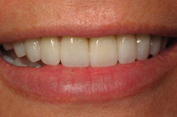 Closeup of smile perfected after smile makeover