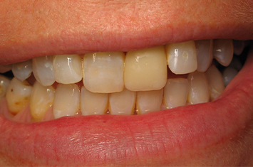 Closeup of slightly crooked and discolored teeth before smile makeover