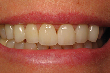 Healthy beautiful smile after smile makeover
