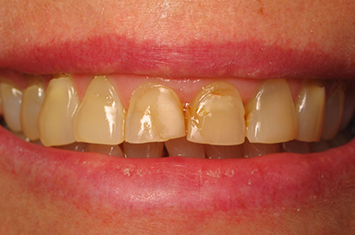 Severely discolored and worn teeth before smile makeover
