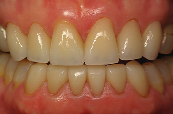 Healthy whtie teeth after full mouth reconstruction