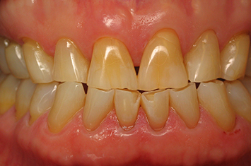 Worn damaged and discolored teeth before full mouth reconstruction