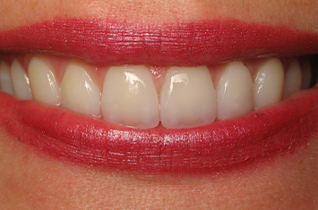 Bright smile after porcelain veneers