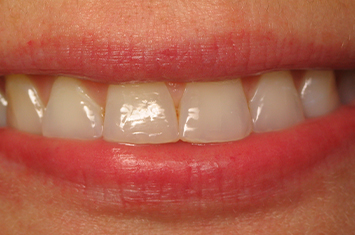 Stained teeth before porcelain veneers