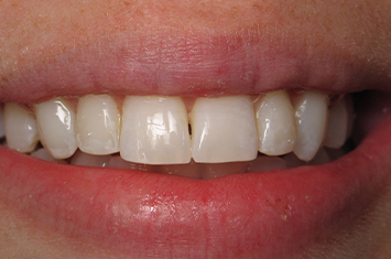 Closeup of perfectly aligned smile after othodontic treatment