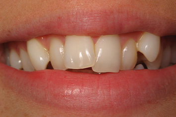 Closeup of crooked teeth before orthodontic treatment