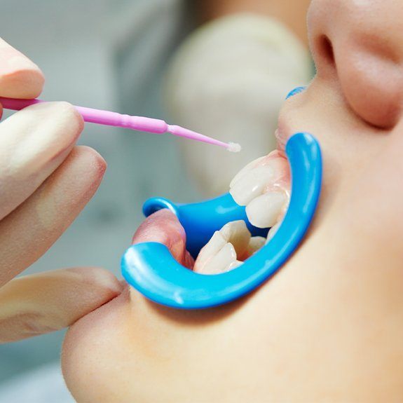 Patient receiving silver diamine fluoride treatment