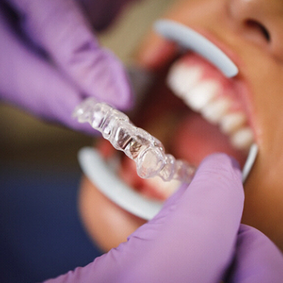 a dentist placing clear aligners in a patient’s mouth