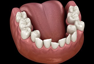 Illustration of crooked teeth