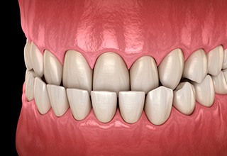 Illustration of an underbite