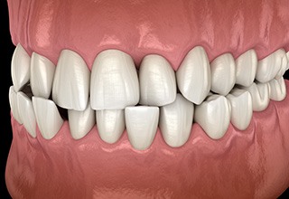 Illustration of a crossbite