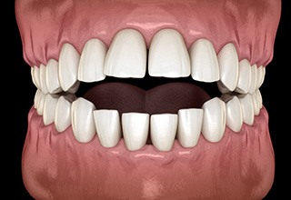 Illustration of an open bite