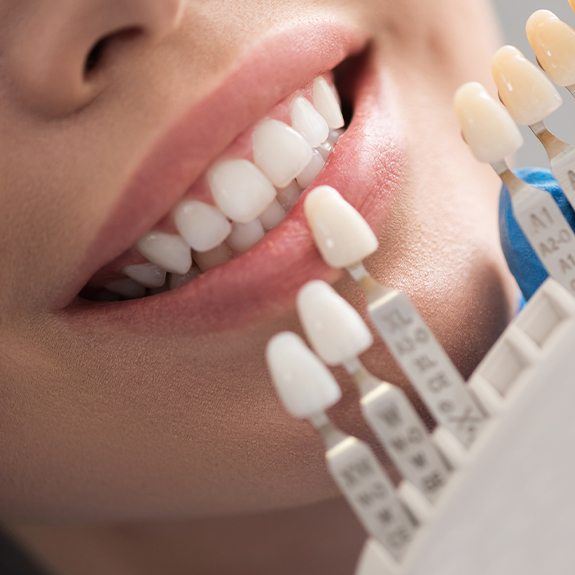 Woman's smile compared with porcelain veneer color chart during cosmetic dentistry checkup