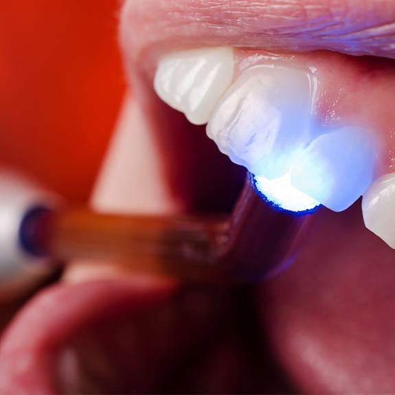 Patient receiving cosmetic dental bonding treatment