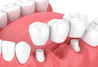 traditional dental bridge