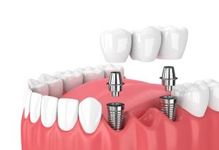 dental bridge supported by two dental implants