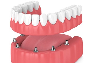 Illustration of dental implants in jaw and dentures in Weatherford, TX