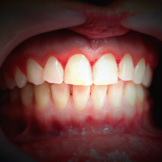 Close-up of a smile with inflamed gums