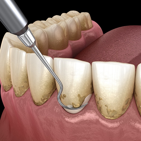 Illustration of scaling and root planing being performed on lower teeth