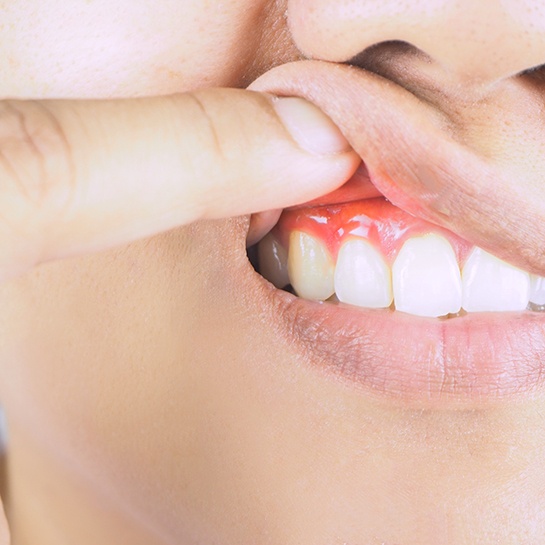 Woman pulling up lip to show signs of gum disease