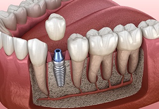 Diagram showing an integrated dental implant in Weatherford