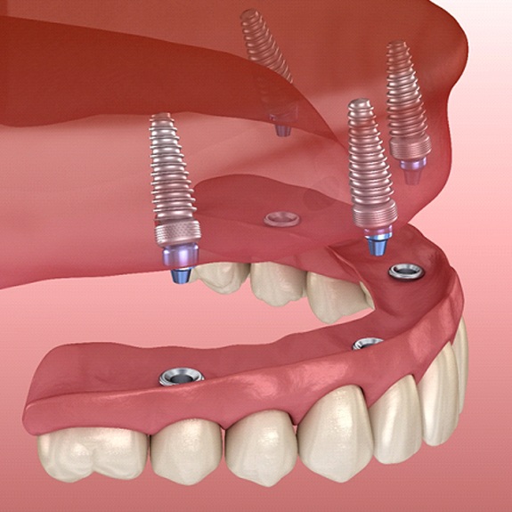 digital illustration of implant dentures in Weatherford