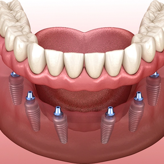 Front-facing diagram of implant denture in Weatherford