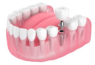 Render of single dental implant in Weatherford, TX with crown and abutment