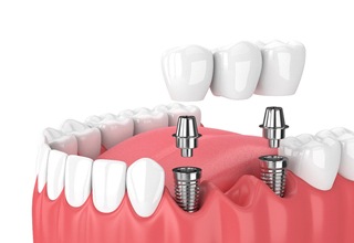 Render of dental bridge being attached to dental implants in Weatherford, TX