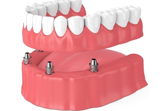Render of dentures being attached to dental implants in Weatherford, TX