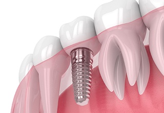 Fully restored dental implant in Weatherford, TX with crown