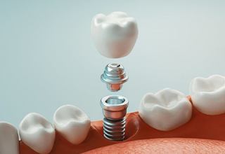 Diagram showing how dental implants work in Weatherford