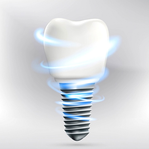 Digital model of a dental implant in Weatherford, TX