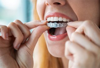 Woman putting mouthguard on her upper arch of teeth