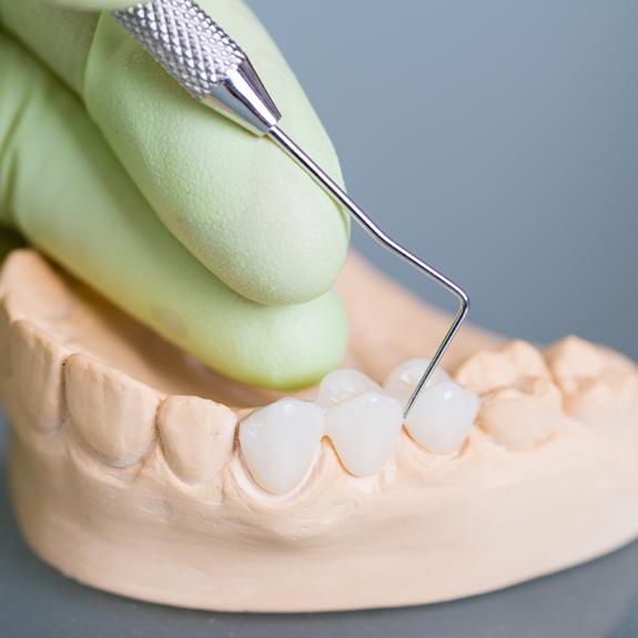 Model smile with fixed bridge restoration