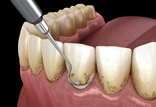 Scaling and root planing can help patients with a lot of buildup around their gumline