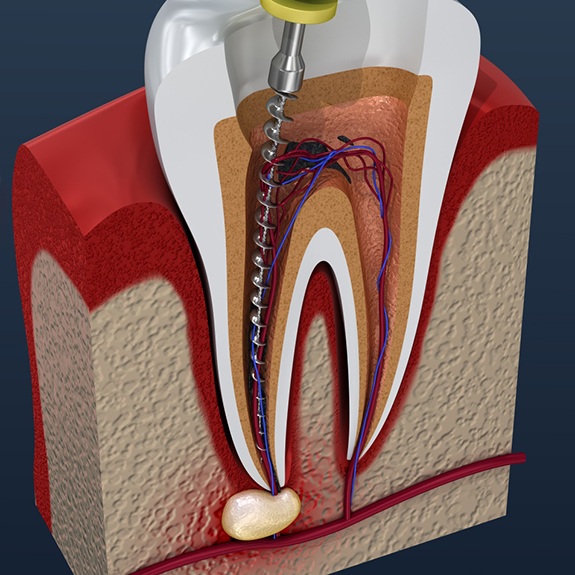 Illustration of dental instrument inside tooth during root canal therapy