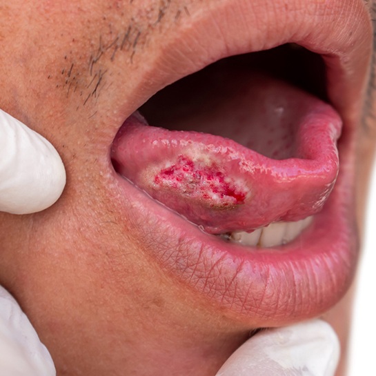 Oral cancer lesion on the tongue