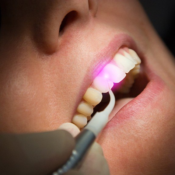 Patient receiving soft tissue laser dentistry treatment